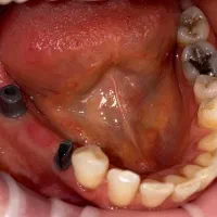 ایمپلنت ارتودنسی کامپوزیت روکش دندانپزشکی|خدمات آرایشگری و زیبایی|ماکو, |دیوار