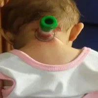 ماساژ،رگ گیری وحجامت