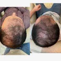 ریش و مو در یک ماه تضمینی