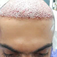 کاشت مو / ریش|خدمات آرایشگری و زیبایی|خرمآباد, |دیوار