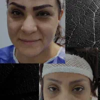 کاشت مو.ابرو.ریش.فول تراکم با شرایط استثنایی|خدمات آرایشگری و زیبایی|شیراز, ستارخان|دیوار