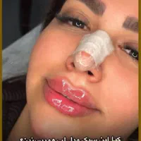 تزریق ژل 390بوتاکس رفع گودی سیاهی زیر چشم لیزر خال|خدمات آرایشگری و زیبایی|تهران, صادقیه|دیوار