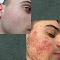 مایع بیو ممتیک ضد لک و ضد جوش