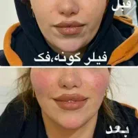 جشنواره50% ژل بوتاکس آنزیم خال مزو زگیل لابیا زگیل|خدمات آرایشگری و زیبایی|کرمانشاه, |دیوار