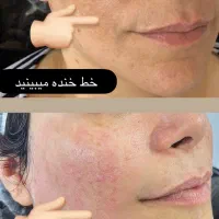 هایفو و جوانسازی صورت باتخفیف باور نکردنی