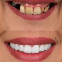 ایمپلنت بدون درد دیجیتال یک روزه شرایط اقساط