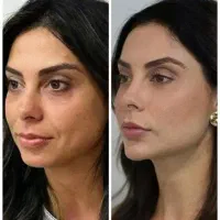 جشنواره ژل بوتاکس نخ فیلر