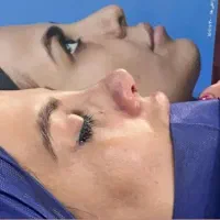 زیبایی بینی