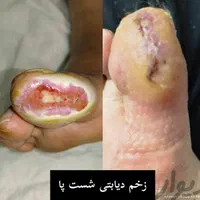 درمان تخصصی زخم‌ دیابتی‌ و زخم‌ بستر|خدمات آرایشگری و زیبایی|شیراز, شهرک پرواز|دیوار
