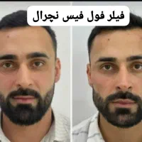فیلر ،جوانساز،بوتاکس ،مزو،نخ جوانساز و لیفت