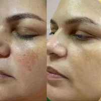 از بین بردن لک صورت