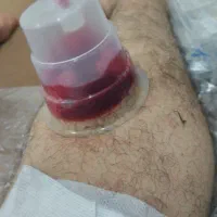 حجامت وزالو درمانی