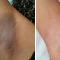 لیزر مو زائد با جدیدترین دستگاه دنیا