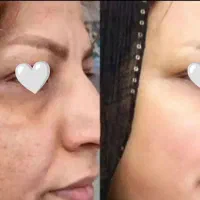 خداحافظی با لک‌های مزاحم