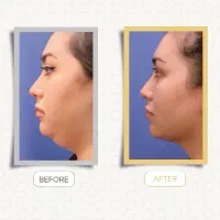 ساکشن غبغب|خدمات آرایشگری و زیبایی|رشت, گلسار|دیوار