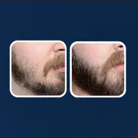 تقویت و رویش ریش