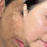 لیزرco2ترکیبی تک جلسه ای هموارساز اف ویژه|خدمات آرایشگری و زیبایی|دوگنبدان, |دیوار