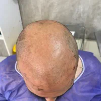 کاشت مو پرتراکم و ابرو با خط رویش طبیعی