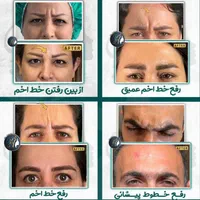 بوتاکس فیلر(ژل) مزوتراپی، پی ار پی درمطب گلسار رشت|خدمات آرایشگری و زیبایی|رشت, گلسار|دیوار