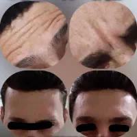 ژل و بوتاکس با ماندگاری بالا و قیمت ویژه|خدمات آرایشگری و زیبایی|شاهین‌شهر, شهرک گلدیس|دیوار