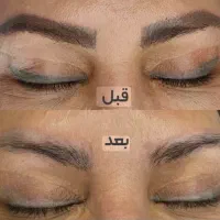 ریموو تتو با متد جدید بدون درد