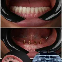 اوردنچر دندان مصنوعی متکی بر پایه ایمپلنت