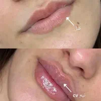 جشنواره تخفیف تزریق و آموزش ژل ،بوتاکس ،مزوتراپی