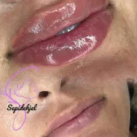 ژل و بوتاکس مزو و انزیم، سیار هستم...