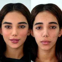 فیلر، ژل ، بوتاکس و آنزیم