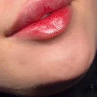 آموزش ژل،بوتاکس،آنزیم،پی ارپی،فیلر بادی