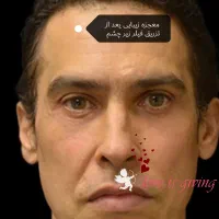ژل لب روسی،بوتاکس بالیوودی، فیلرزیر چشم،لیفت شقیقه|خدمات آرایشگری و زیبایی|مشهد, سرافرازان|دیوار