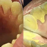 جرم گیری (لیزری ) دندانپزشکی