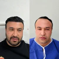 کاشت مو و ابرو.با شرایط ویژه پنچ تومن|خدمات آرایشگری و زیبایی|تبریز, |دیوار