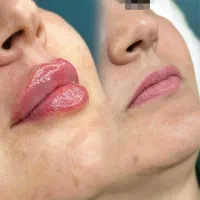 of تا فرداژل و بوتاکس مزو ژل مزو تراپی  prp|خدمات آرایشگری و زیبایی|مشهد, امام رضا (ع)|دیوار