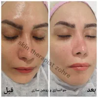 پاکسازی آبرسانی و فیشال پوست صورت