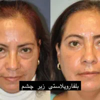 افتادگی پلک،بلفاروپلاستی،سانترال لب،بوکال فت،غبغب|خدمات آرایشگری و زیبایی|تهران, پاسداران|دیوار