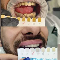 آموزش تخصصی دندانسازی و بلیچینگ و کامپوزیت