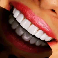 افر ویژه کامپوزیت دندان با گارانتی