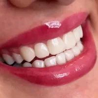 کامپوزیت و لمینیت دندان