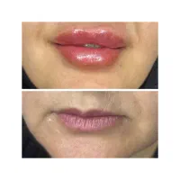 جراح پلک بلفارو ژل چربی صورت ساکشن شکم بوتاکس لیزر