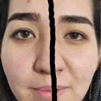 جشنواره هایفوتراپی vipبامتریال مخصوص پوستتون