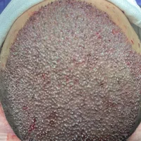 کاشت مو با روش میکروگرفت