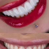کامپوزیت دندان /طرح لبخند( اقساط)|خدمات آرایشگری و زیبایی|مشهد, راهنمایی|دیوار