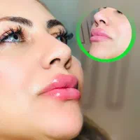 ساکشن غبغب و شکم فیلر بادی پی ار پی ژل و بوتاکس|خدمات آرایشگری و زیبایی|شیراز, قصرالدشت|دیوار