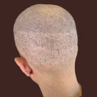 میکرواسکالپ|خدمات آرایشگری و زیبایی|رشت, گلسار|دیوار
