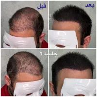 اسکالپ مو رفع کم پشتی مو