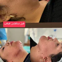 حذف پف پلک و افتادگی بوتاکس،ژل،بوکال،سانترال،هایفو|خدمات آرایشگری و زیبایی|تبریز, |دیوار