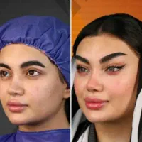 جشنواره جراحی های زیبایی بلفارودایرکت ابروساکشن