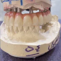 دوره آموزش پروتز ثابت