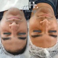 فیشال‌درمطب/درمان‌جوش‌وخشکی/هایفو|خدمات آرایشگری و زیبایی|قم, دورشهر|دیوار